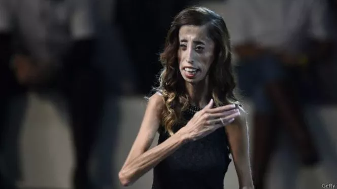 150314194956_lizzy_velasquez_mujer_mas_fea_del_mundo_624x351_getty
