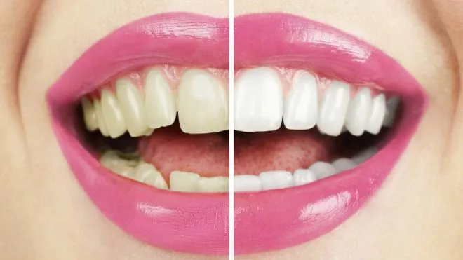 150925120338_blanqueo_dental_624x351_thinkstock_nocredit