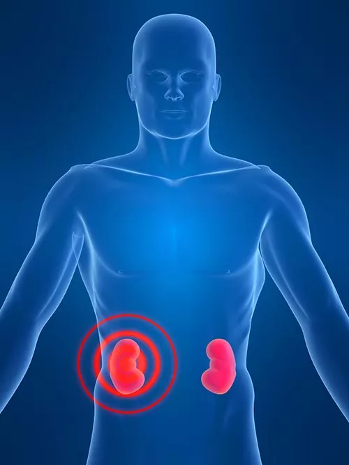 insuficiencia-renal