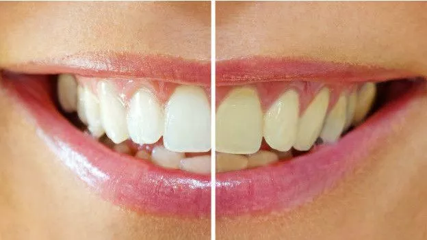 160419123530_dientes_624x351_thinkstock_nocredit