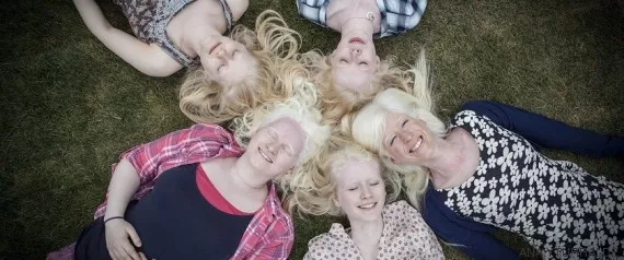 albinos