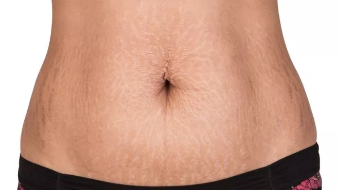 _93772988_estrias_barriga_thinkstockphotos-485046828