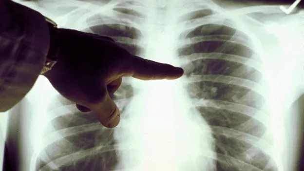 _96877903_pulmones