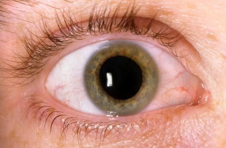 retinopatia-diabetica