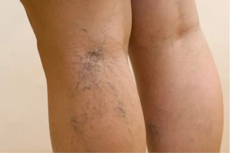 varices2