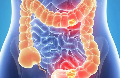 cancer-colorrectal