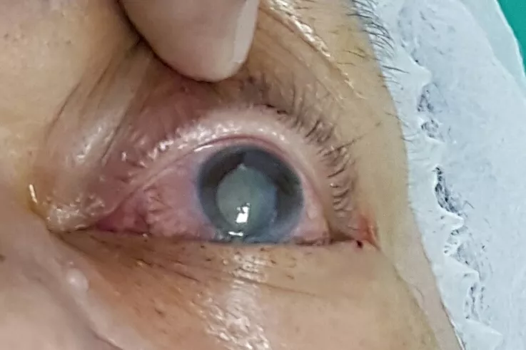 catarata-en-ojo