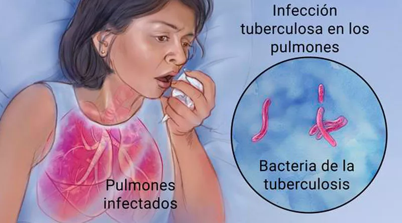 tuberculosis