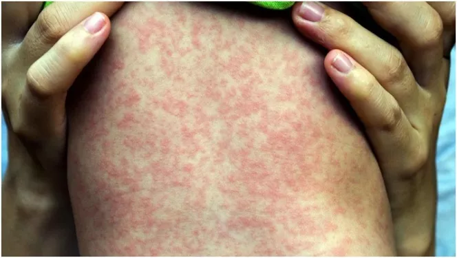 declaran-emergencia-de-salud-en-ny-por-epidemia-sarampion
