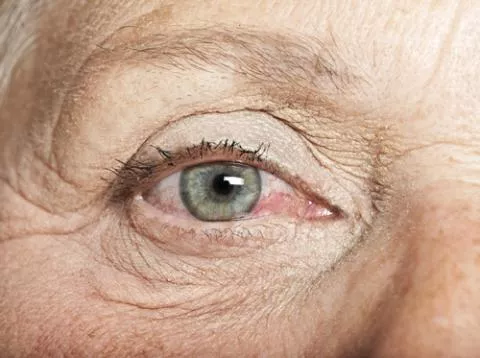 ojo-seco