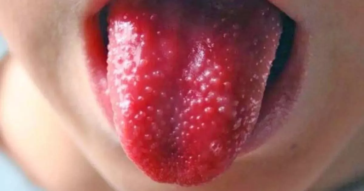 enrojecimiento-lengua