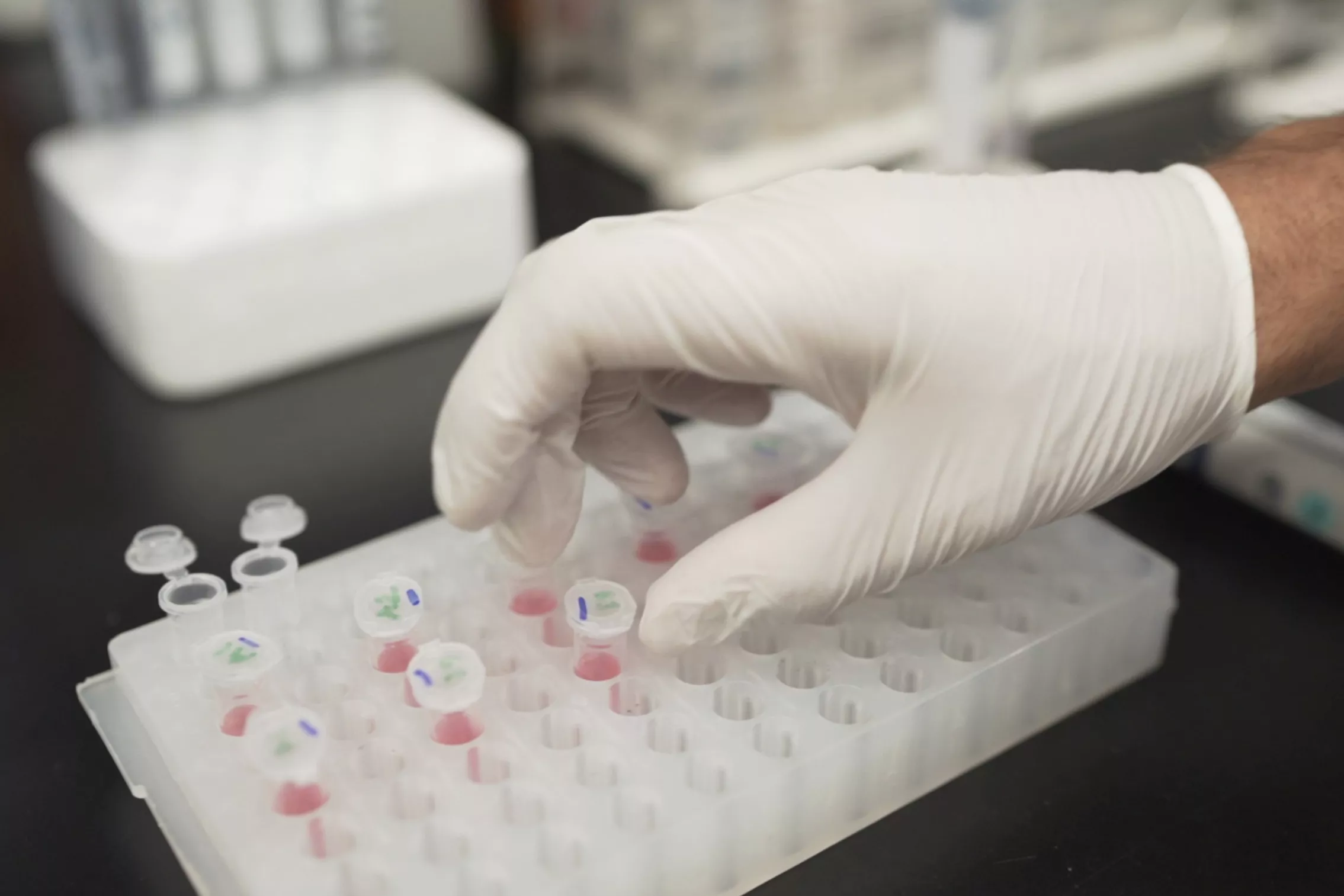 Alzheimer Blood Test