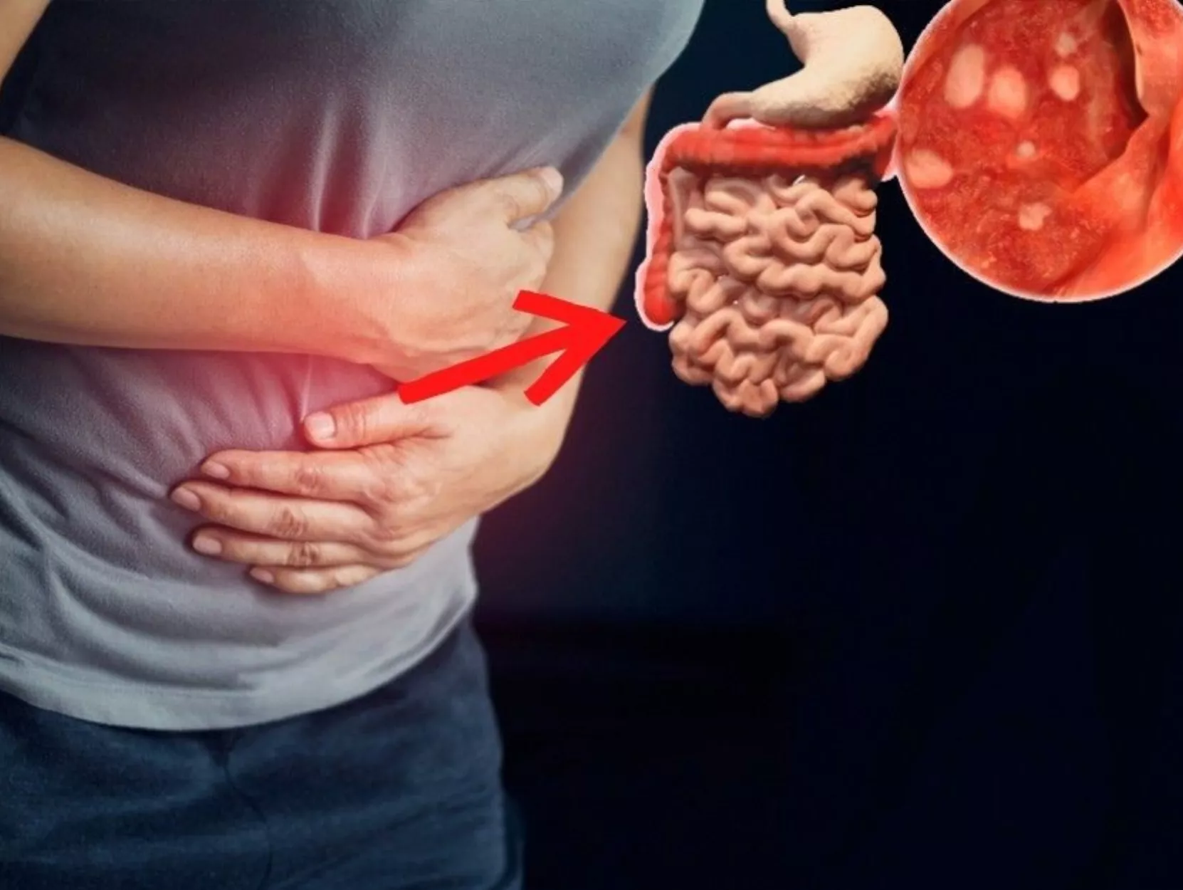 Colitis ulcerativa,