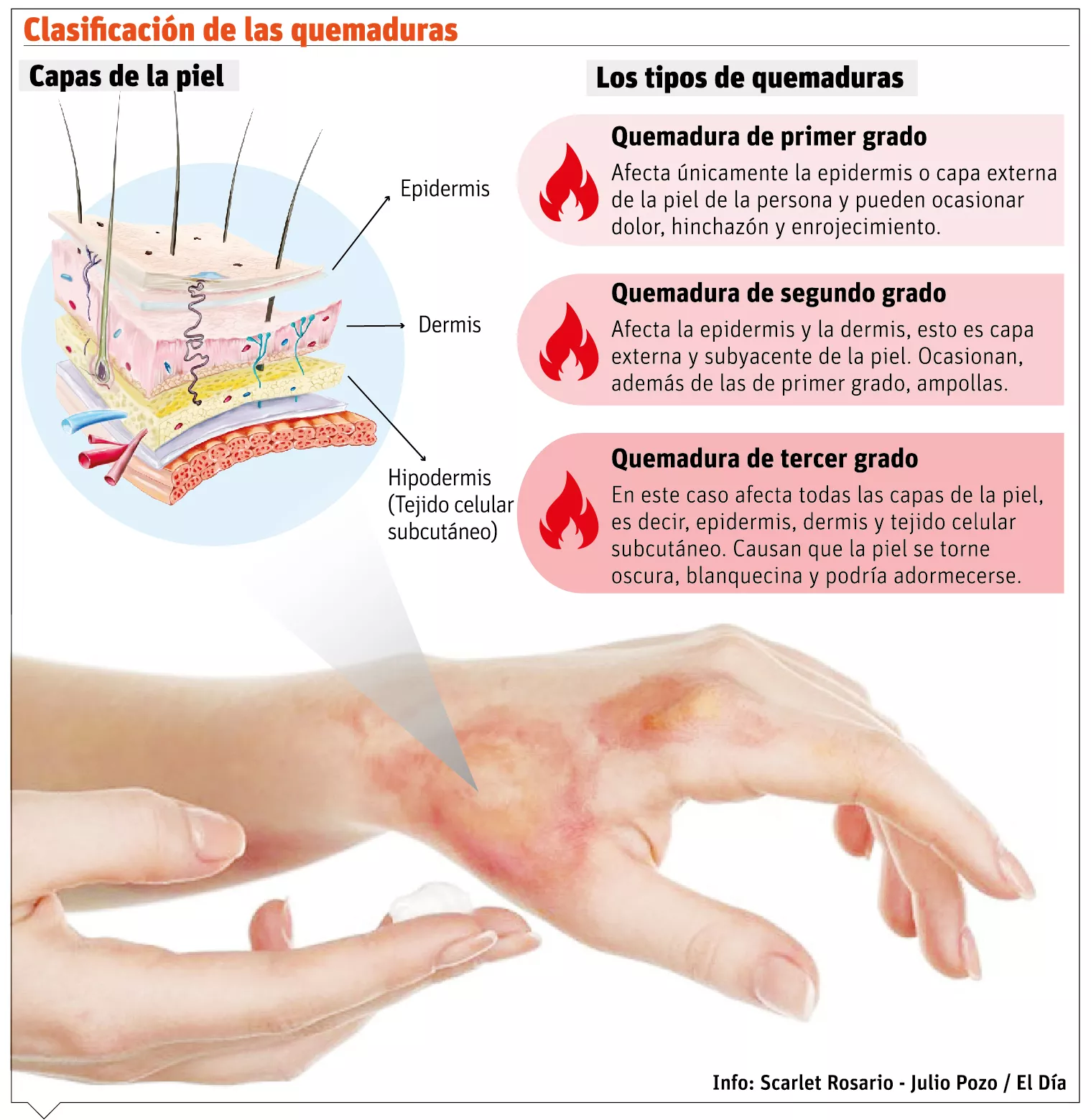 info-QUEMADURAS