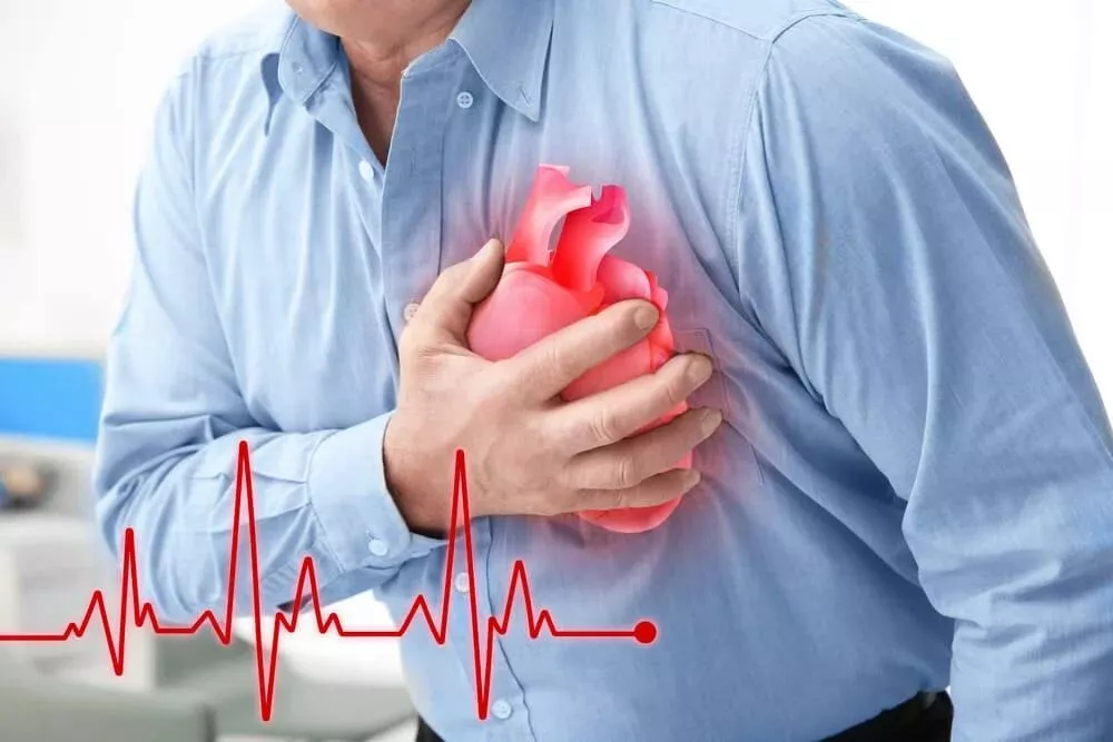 INFARTO