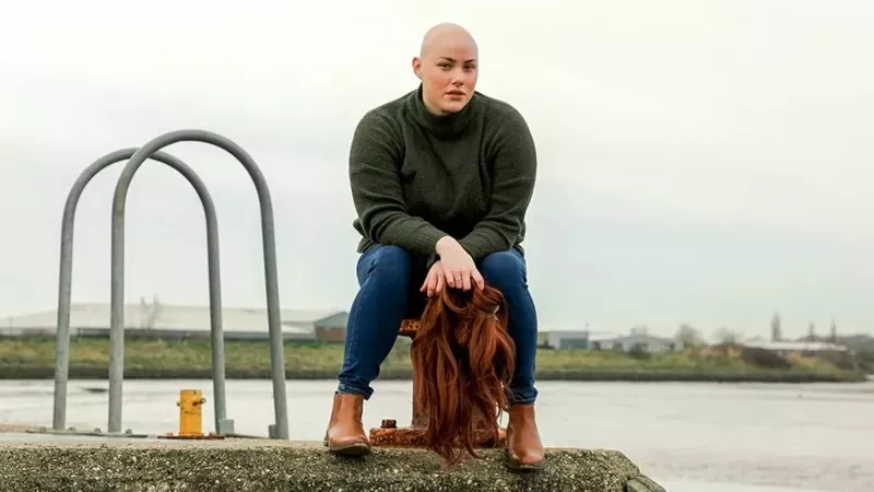 alopecia