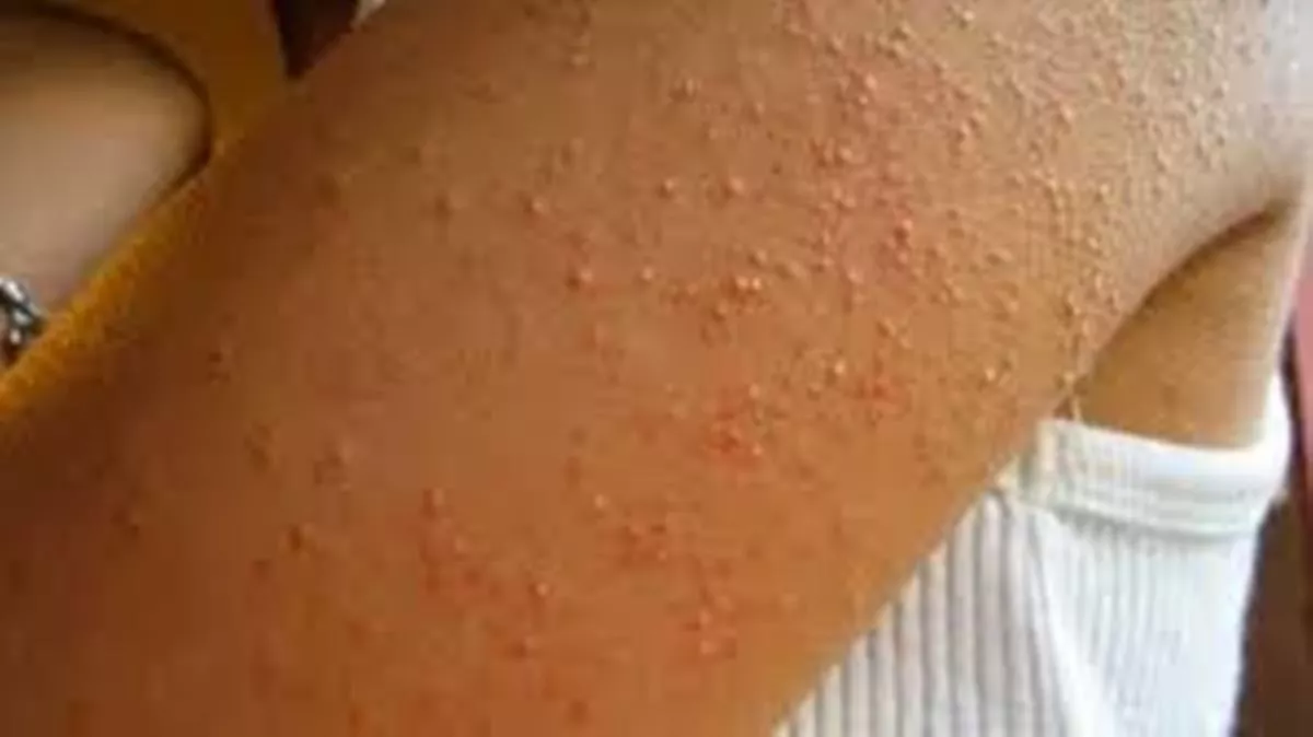escabiasis