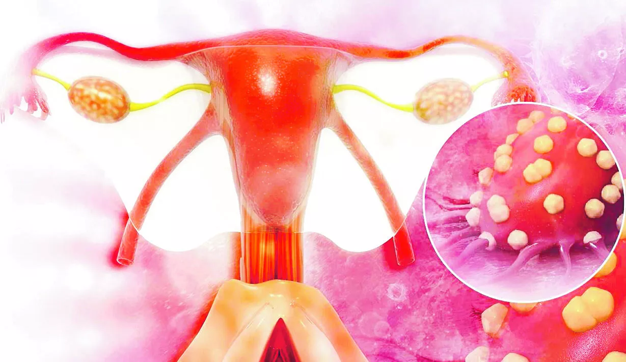 El  cáncer de ovario es el  más letal del sistema reproductivo femenino.