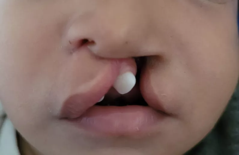 Jornada Cirugía Labio Leporino  inició el pasado lunes.