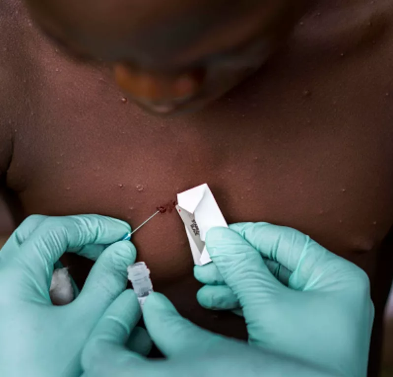 CDC (Center of Disease Control) Team in Republic of Congo Study MonkeyPox Virus