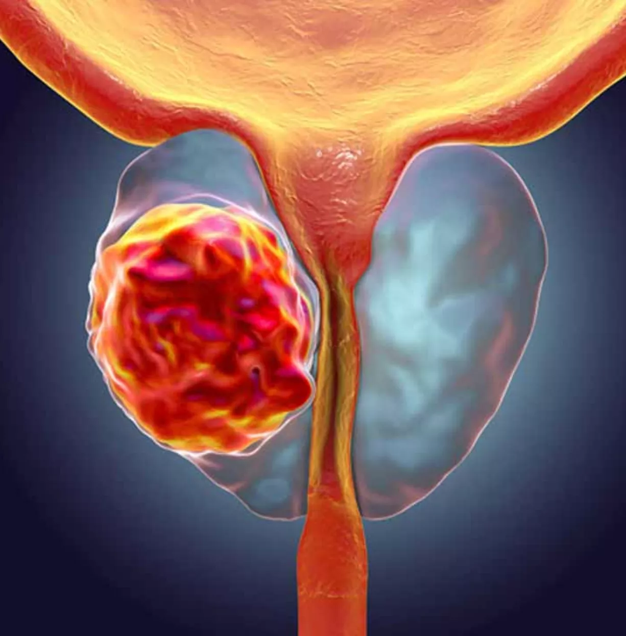 En la etapa inicial el paciente con cáncer de próstata se mantiene sin presentar síntomas.