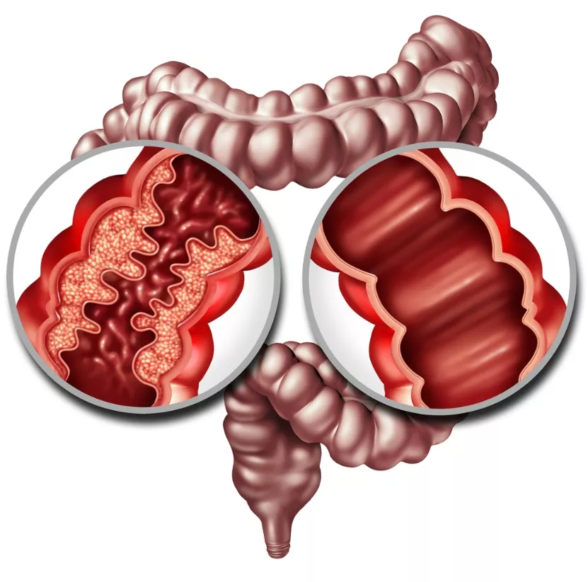 Crohn Disease And Healthy Intestine