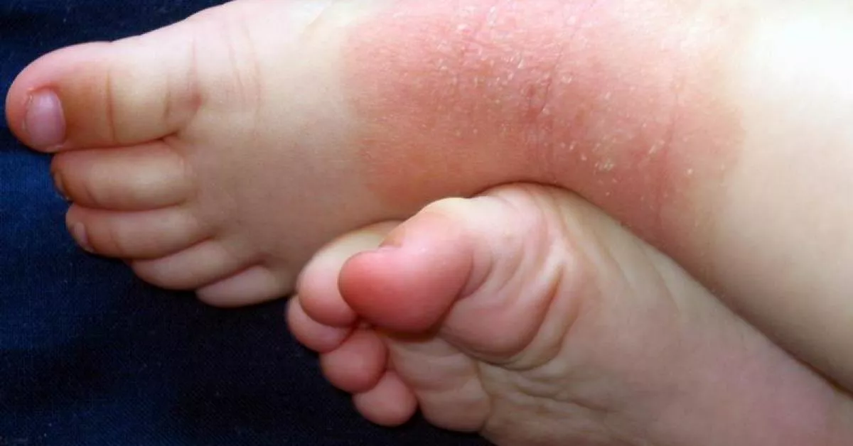 dermatitis