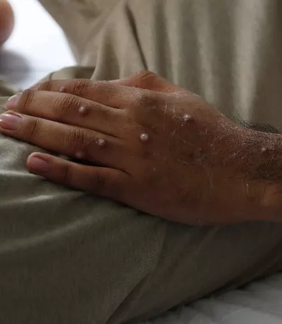 La viruela del mono, una amenaza creciente en Perú