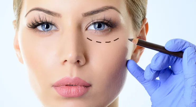 blefaroplastia (1)