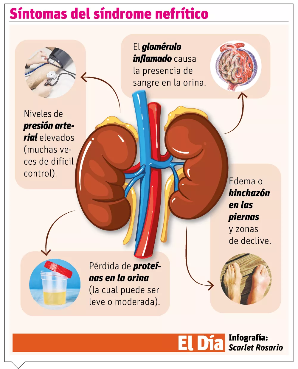 info-NEFRITICO