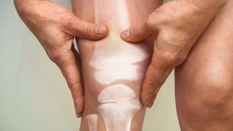 Osteoporosis