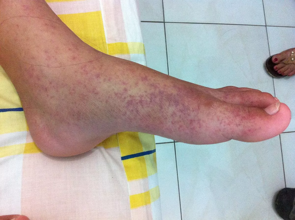 1200px-2012-01-09_Chikungunya_on_the_left_feet_at_The_Philippines