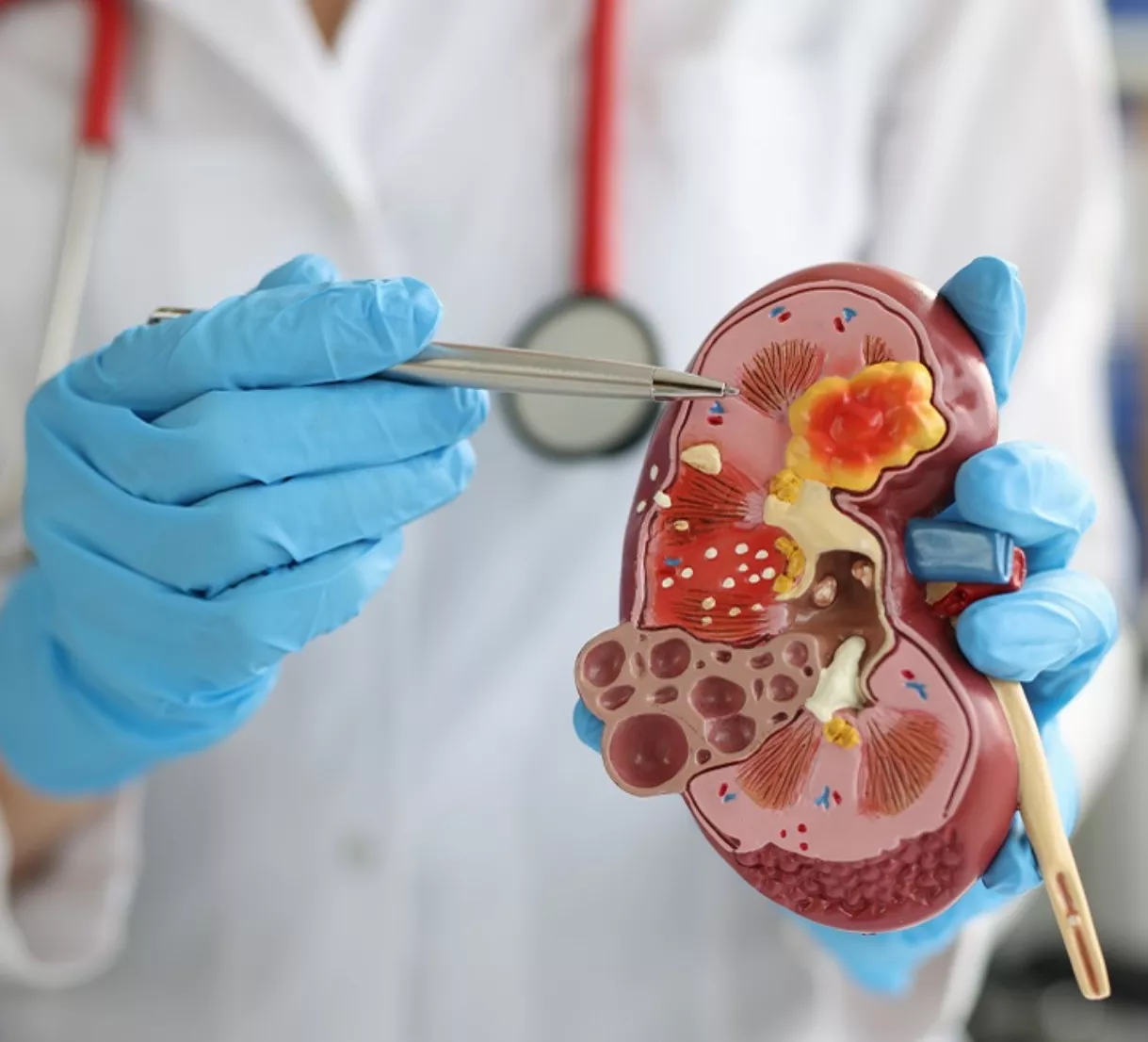 Cuando se presenta de manera recurrente  puede producir cicatrices en  parenquima renal.