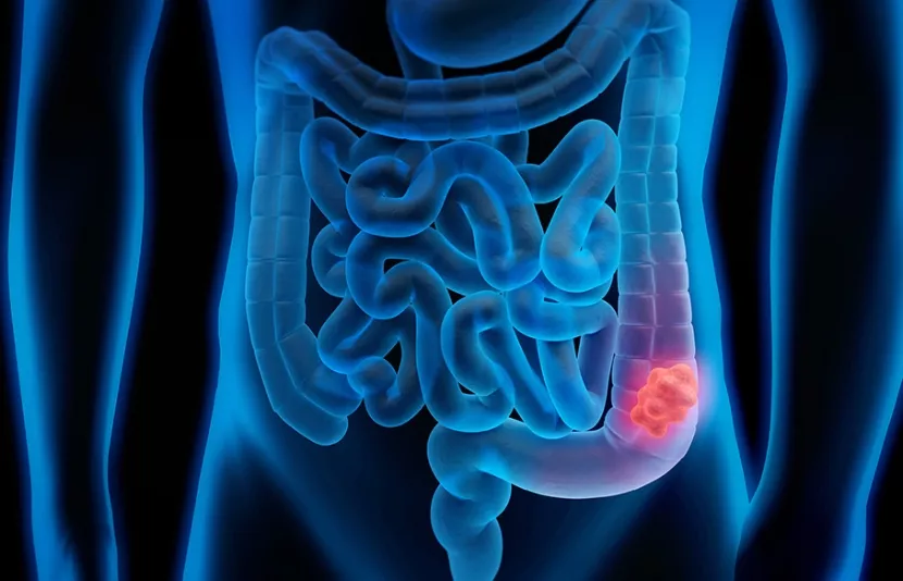 A  menudo se les diagnostica en etapas más avanzadas.