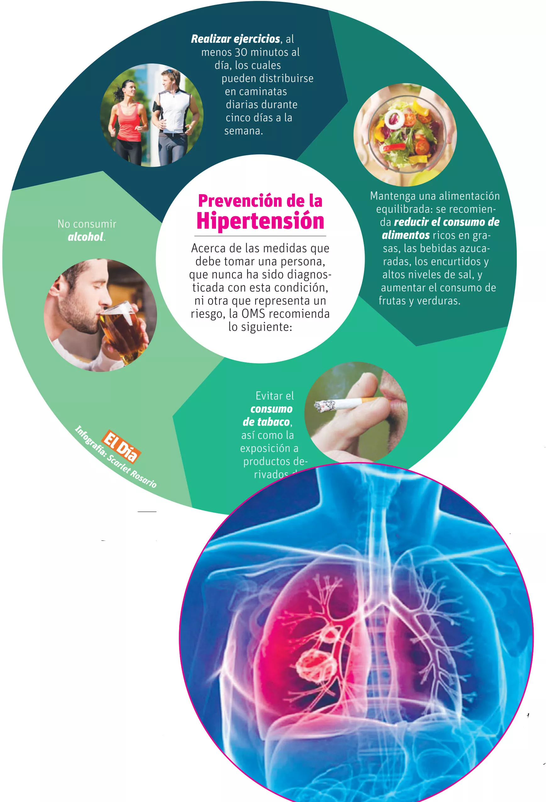 hipertensión