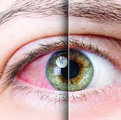 Existen diferentes clasificaciones para el ojo seco.