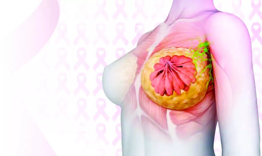 cáncer de mama