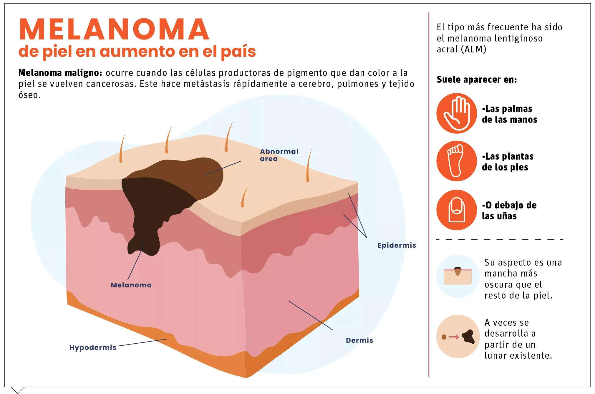 info-MELANOMA PIEL
