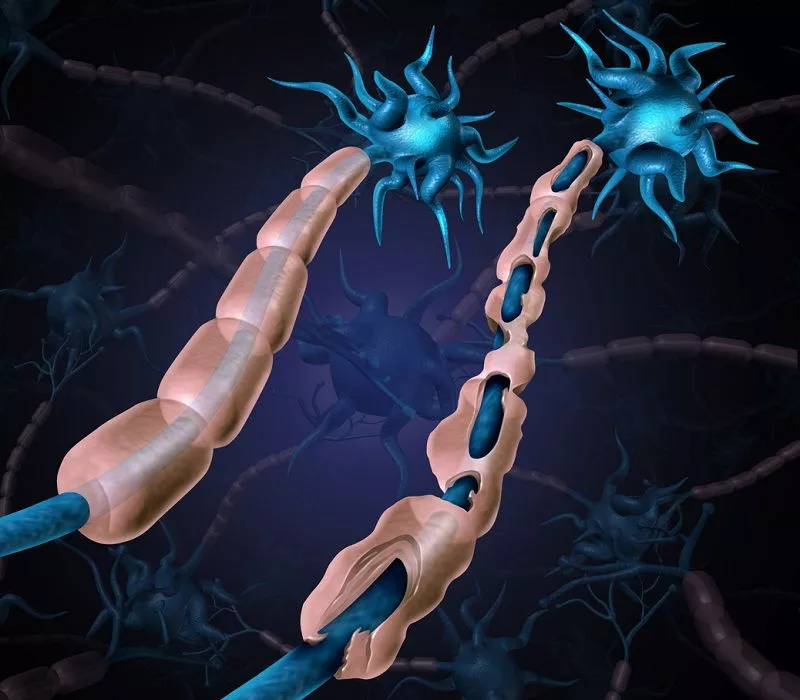 esclerosis-multiple-causas