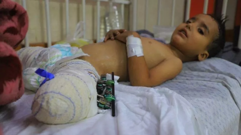 Ahmed Shabat, de 3 años, perdió sus piernas en una explosión en Gaza.