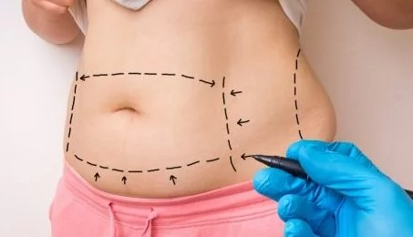 liposuccion