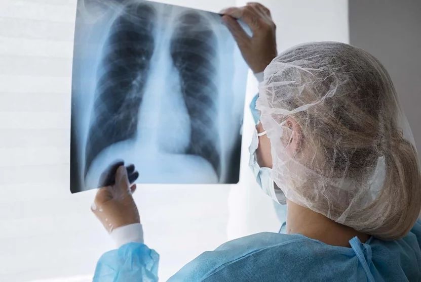 La Tuberculosis pulmonar es una de las más comunes.