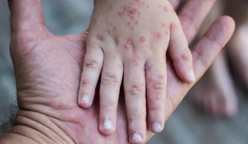 Sarampión es una enfermedad vírica muy contagiosa.