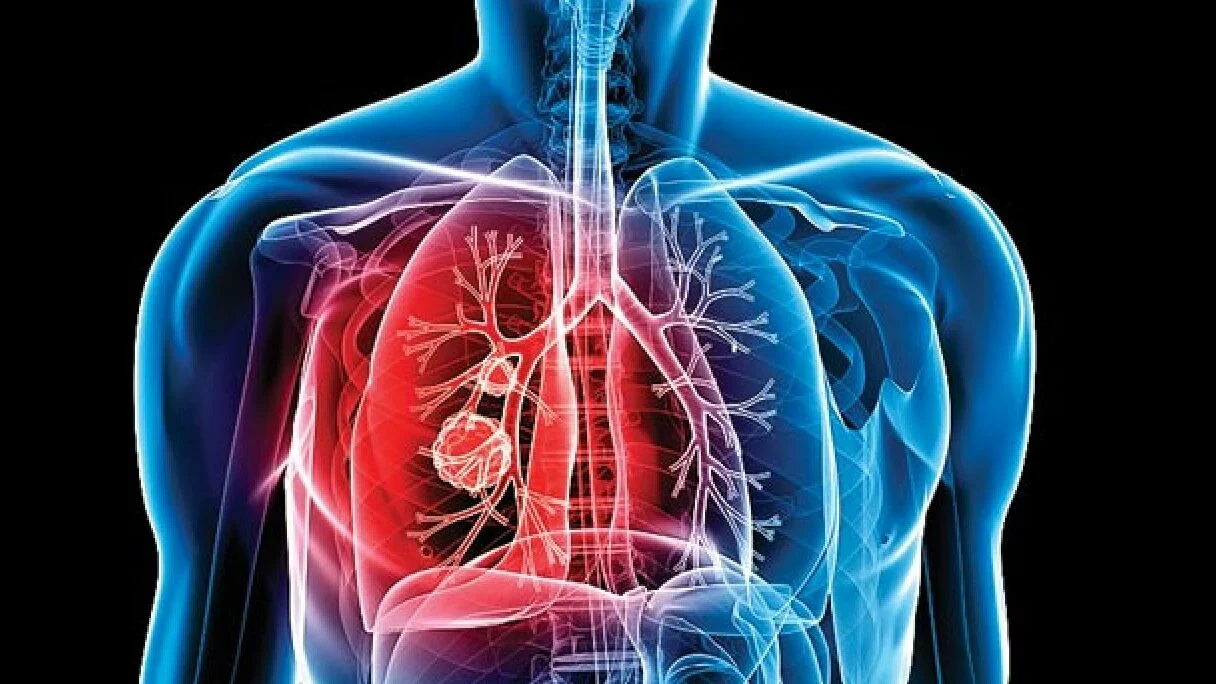 Tuberculosis