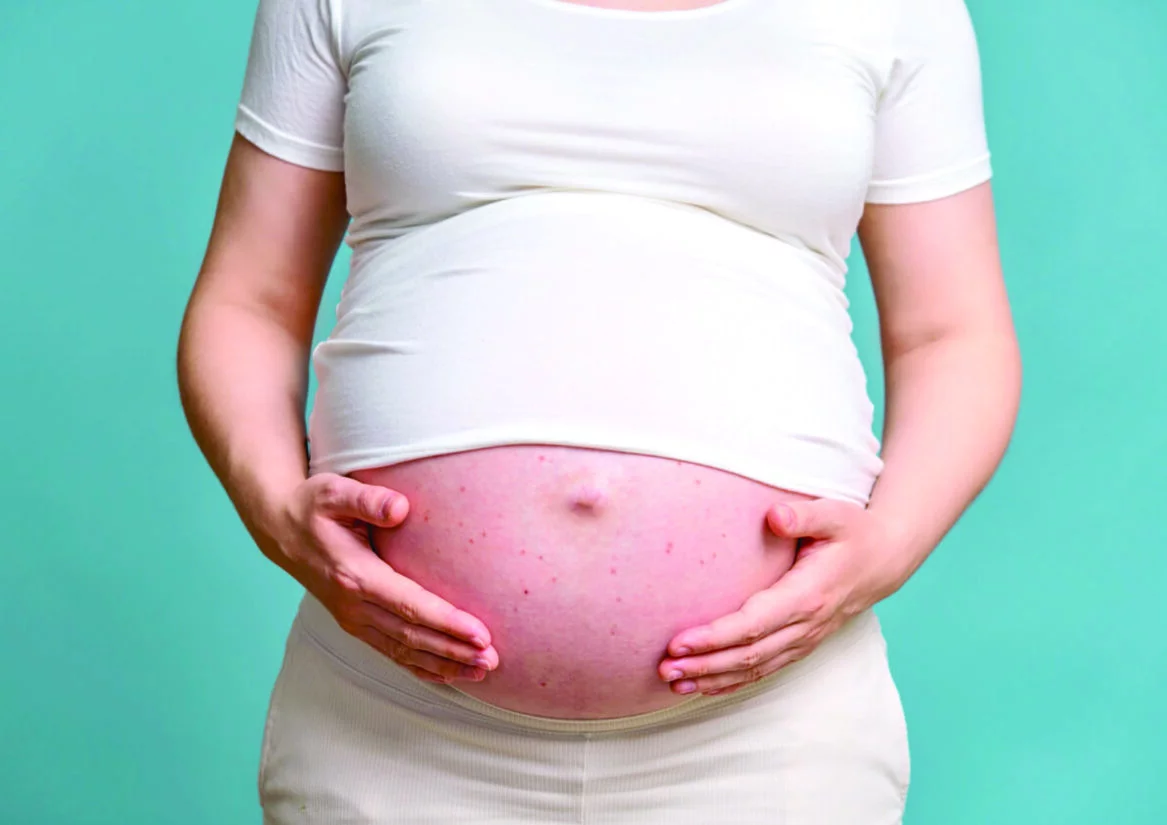 La mayoría de los cambios cutáneos relacionados con el embarazo son normales, pero es vital acudir al dermatólogo.