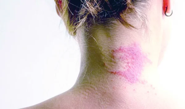 dermatitis1