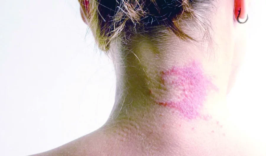 dermatitis1