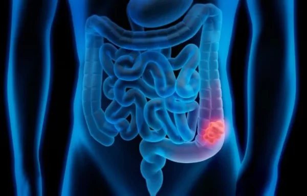 Cáncer colon