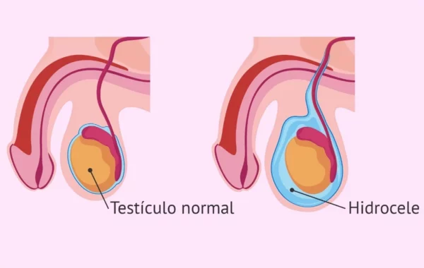 Los pacientes pueden tener un aumento de volumen escrotal, progresivo y generalmente indoloro.