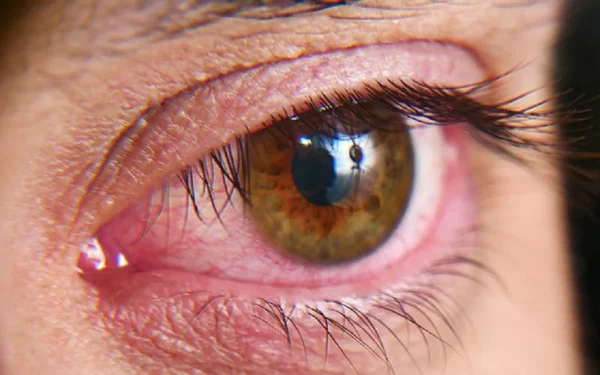 Características de un ojo seco.
